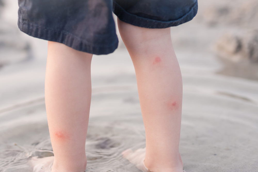 Аллергия на Укусы Блох у Ребенка